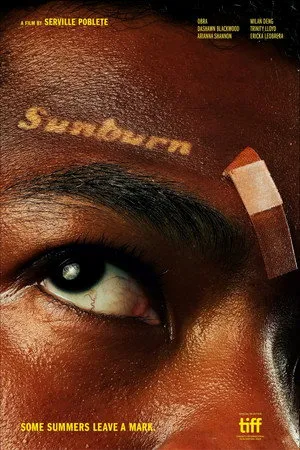 Sunburn